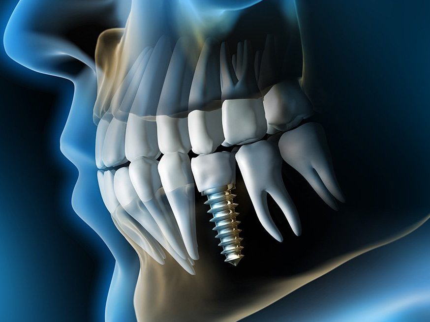 ایمپلنت دندان به چند روش انجام می‌شود و هر یک مناسب چه افرادی هست؟