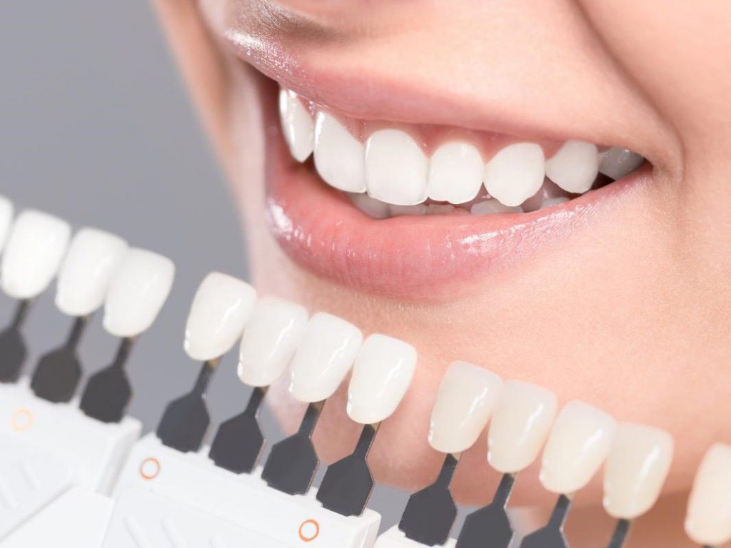 لمینت دندان بهتر است یا کامپوزیت دندان؟