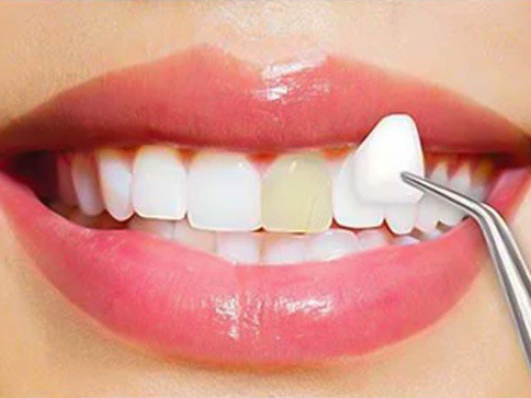 مدت زمان ماندگاری ونیر دندان چقدر است؟