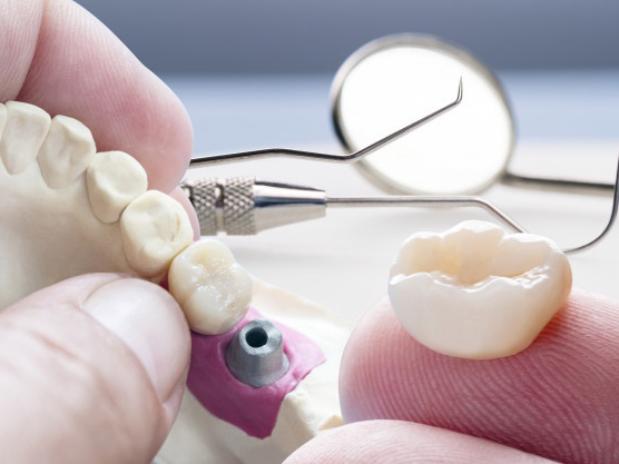 کاربرد، معایب و مزایای ایمپلنت دندان
